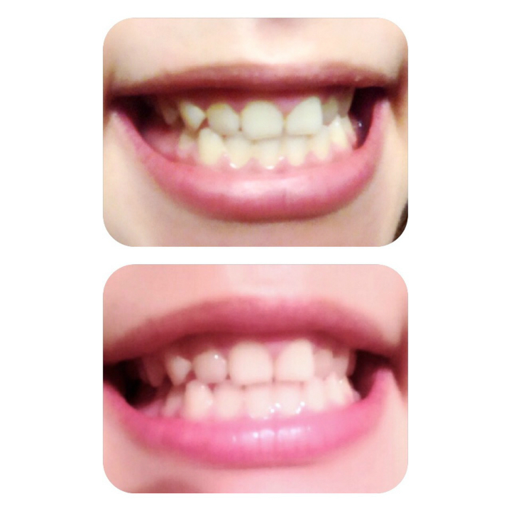 ＠GIRL_薬用ﾊﾟｰﾙﾎﾜｲﾄproEX＋_miku