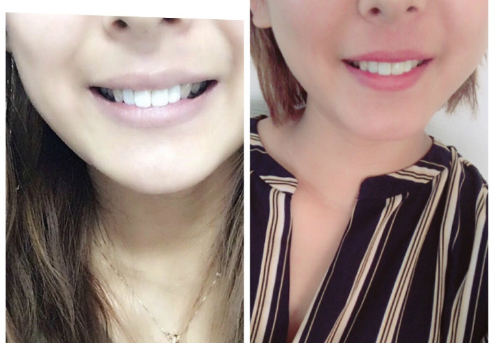 ＠GIRL_薬用ﾊﾟｰﾙﾎﾜｲﾄproEXﾌﾟﾗｽ_みきてぃ