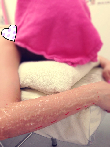 おまめ×脱毛ラボ